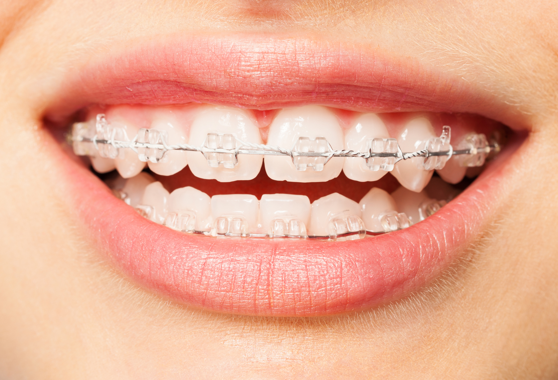 Fixed Metal & Ceramic Braces Wirral - Buckle Wirral Dentists
