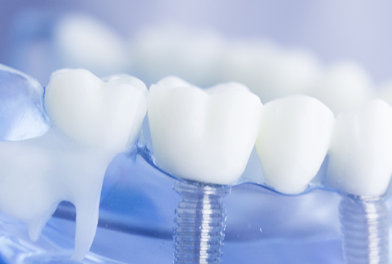 Dental Implants & Tooth Implants WirralÂ - Buckle Wirral Dentists